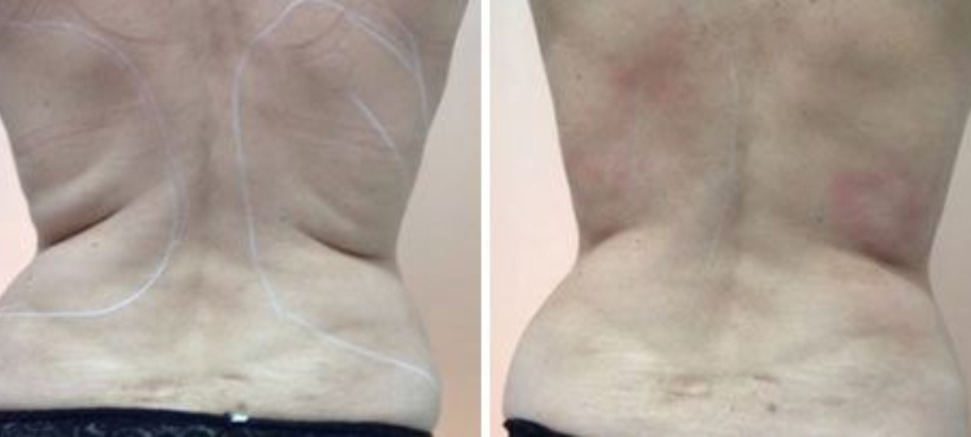 rmc-tightsculpting2-kopia