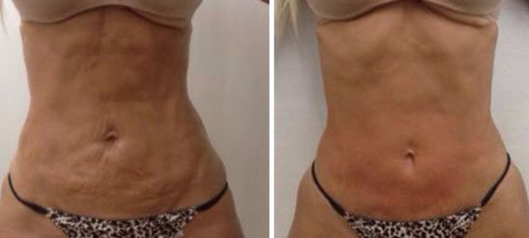 rmc-tightsculpting3